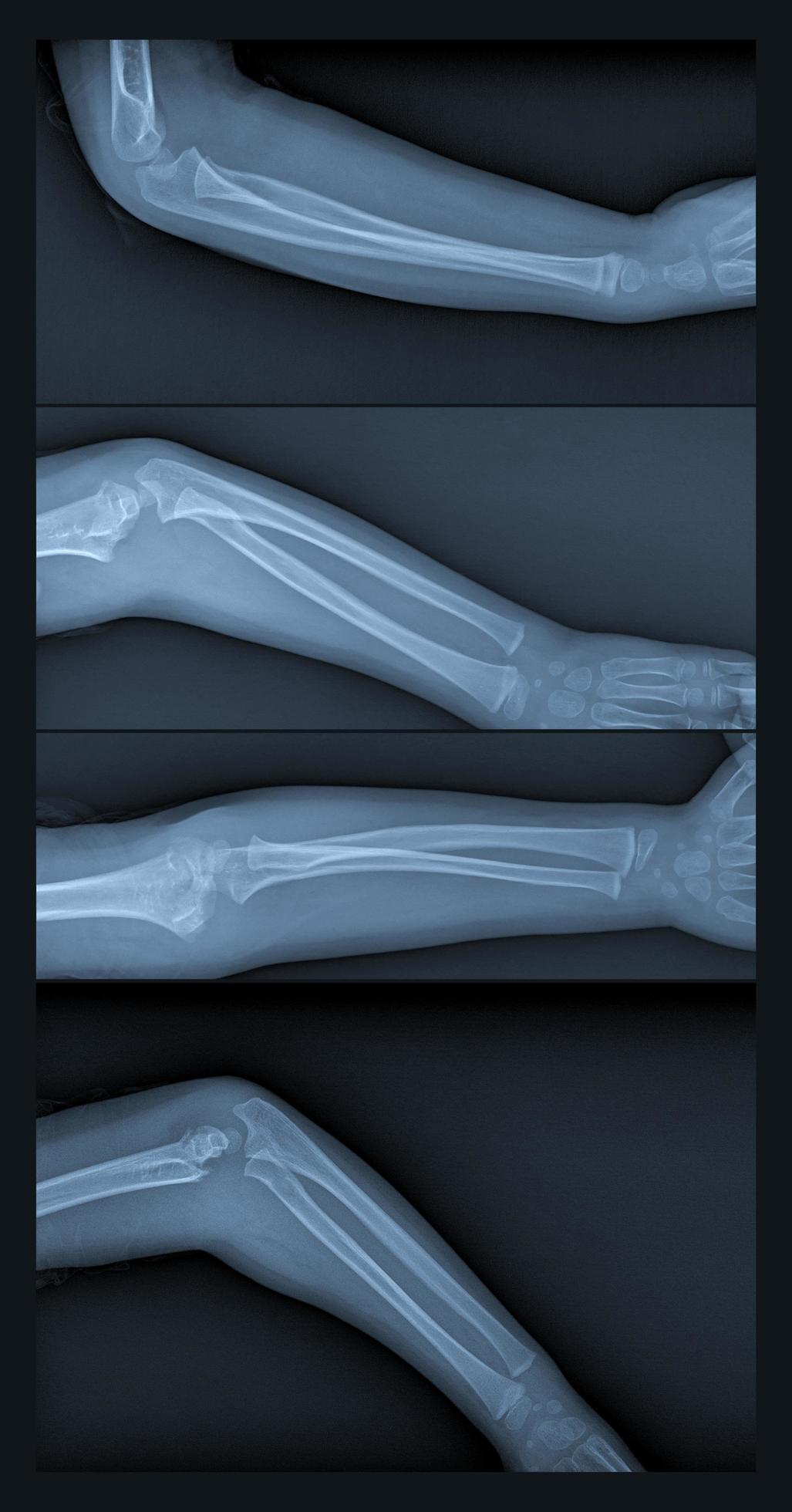 Broken arm xray Stock Free